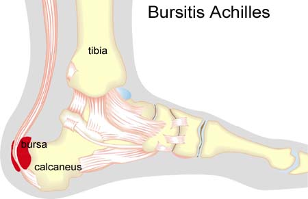 the Achilles to the heel bone 