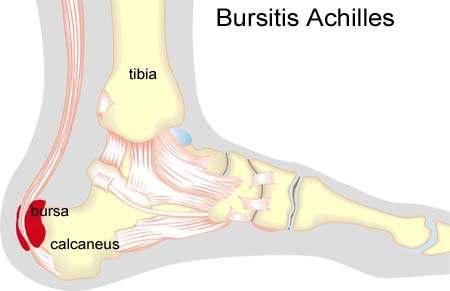 inflammation of heel tendon