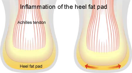 Inflammation of the heel fat pad 