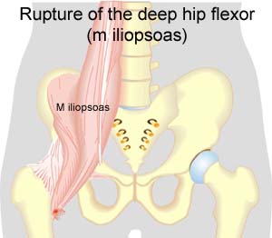 iliopsoas tendon