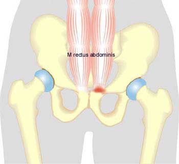 Inflammation of the abdominal muscle at the point of attachment on